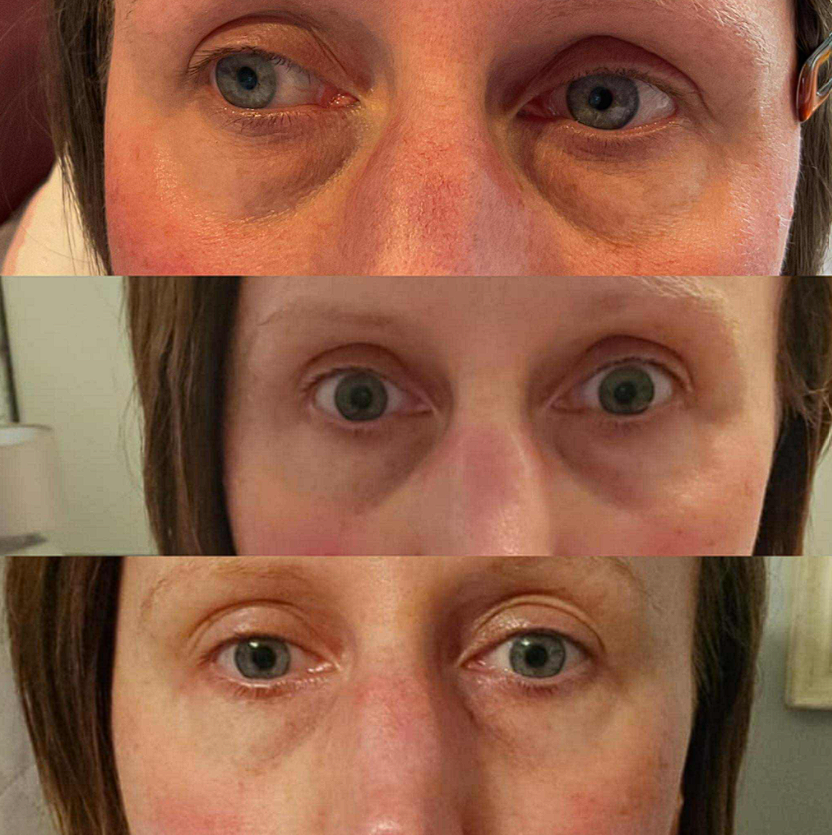 Radiofrequency
