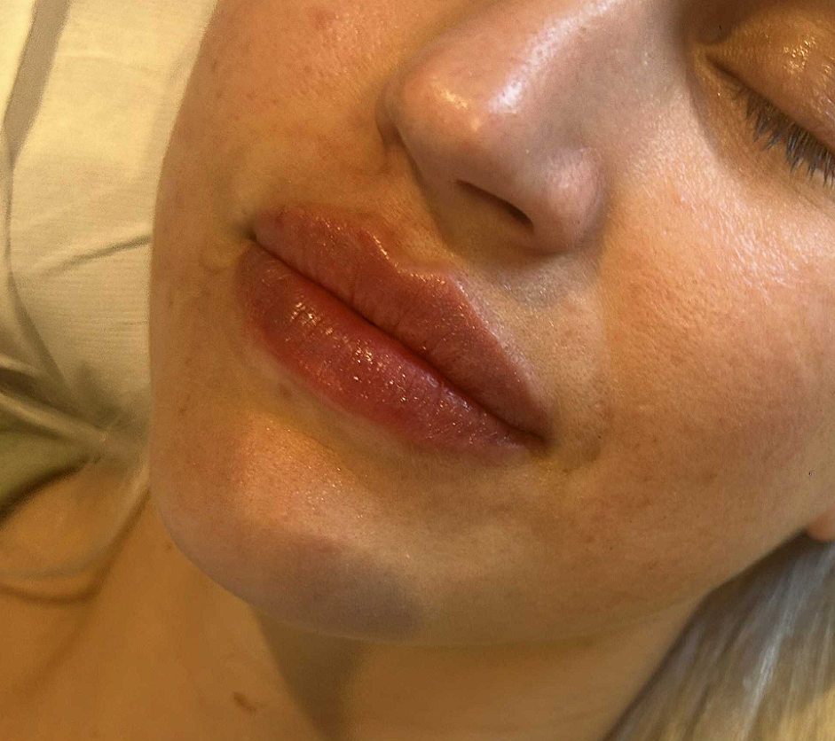 Post Retinol Peel