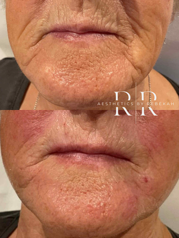 Microneedling